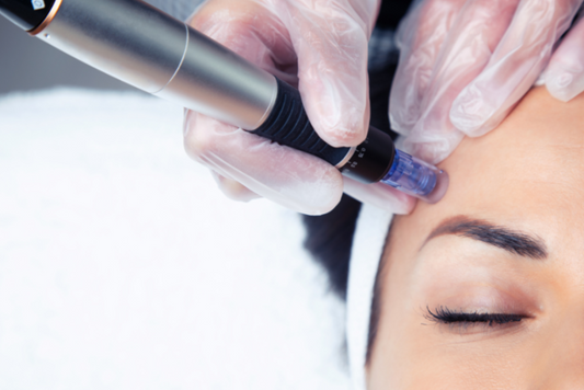 Microneedling